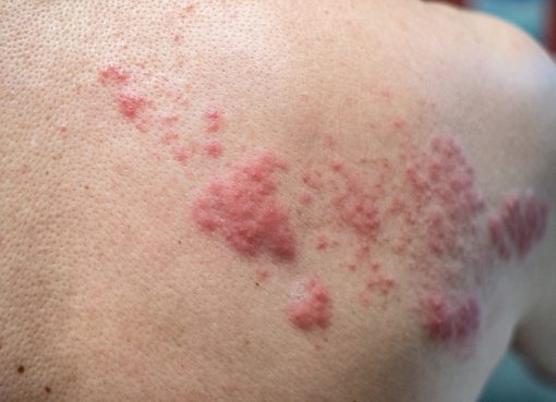 حملات توعوية لتصحيح المفاهيم الخاطئة حول الحزام الناري وتعزيز التوعية بطرق الوقاية منه .. بمناسبة الأسبوع العالمي للتحصينات